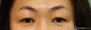 症例写真 術前 眉下切開法