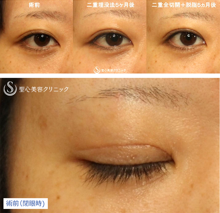 二重術 目頭切開 涙袋 眼瞼下垂 二重 の症例写真 聖心美容クリニック横浜院 二重術 目頭切開 涙袋 眼瞼下垂 二重 の症例写真 聖心美容クリニック横浜院