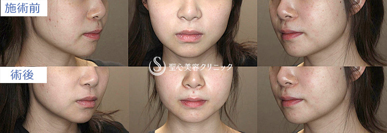 症例写真　術前術後　小顔の整形