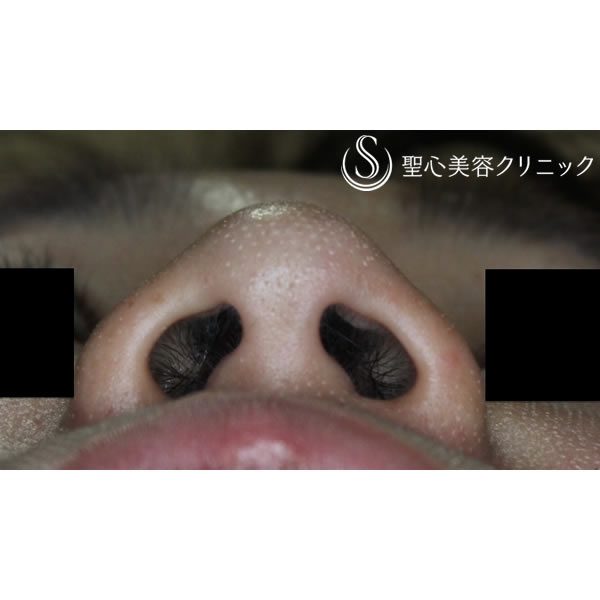 症例写真 術前 鼻の整形