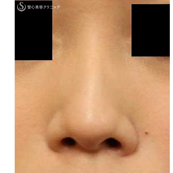 症例写真 術前 鼻の整形