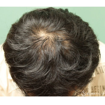 症例写真 術後 毛髪再生療法 KIPスカルプヘアエッセンス