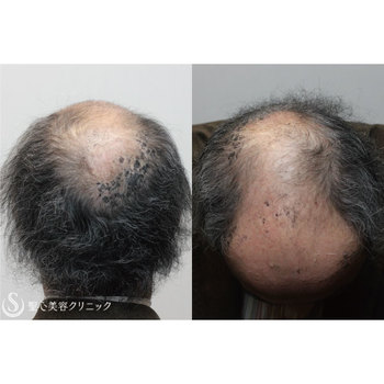 症例写真 術後 毛髪再生療法 グロースファクター再生療法