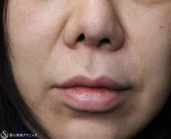 症例写真 術前 鼻孔縁複合組織移植術