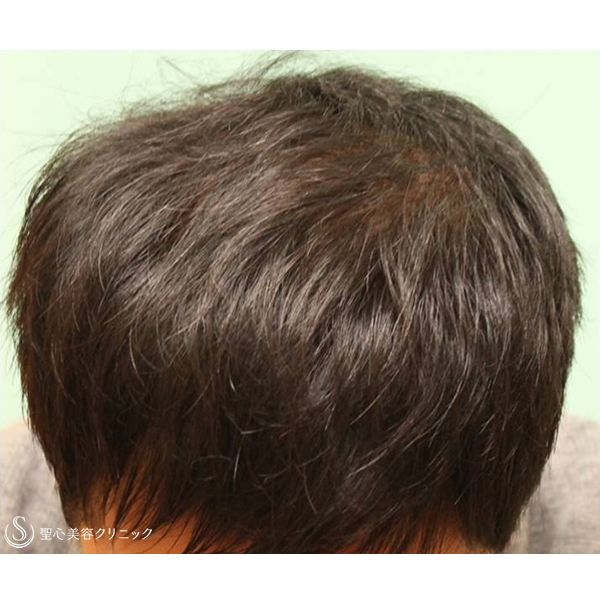症例写真 術後 毛髪再生療法 KIPスカルプヘアエッセンス