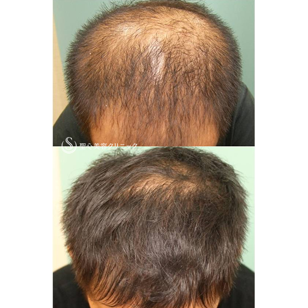 症例写真 術前 毛髪再生療法 KIPスカルプヘアエッセンス
