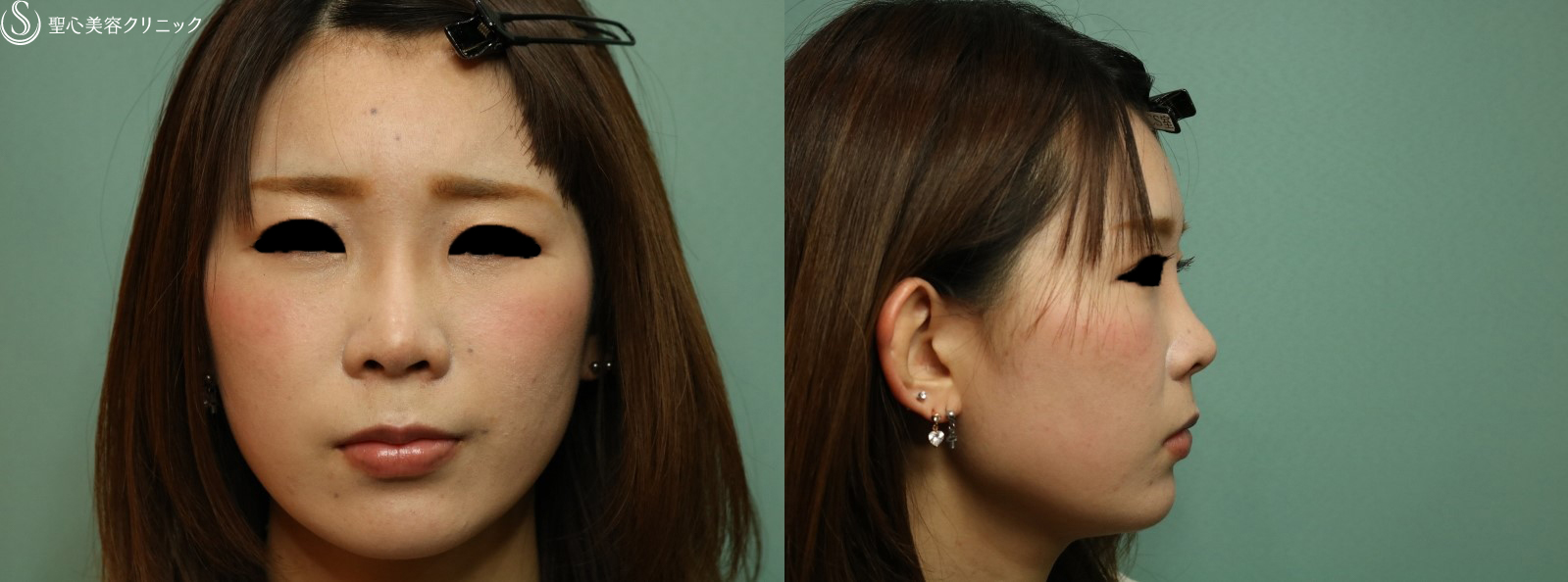 症例写真 術後 プロテーゼによる隆鼻術