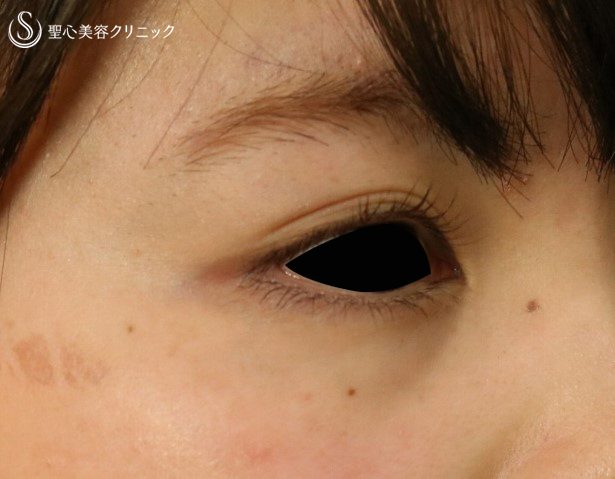 症例写真 術前 プレミアムPRP皮膚再生療法