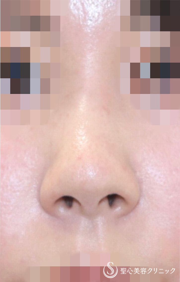 鼻の整形 鼻先 の症例写真 聖心美容クリニック横浜院