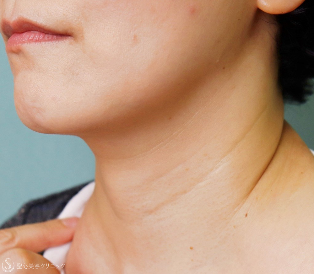 プレミアムPRP皮膚再生療法_Before