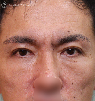 プレミアムPRP皮膚再生療法+眉下切開法（眉下リフト）_After