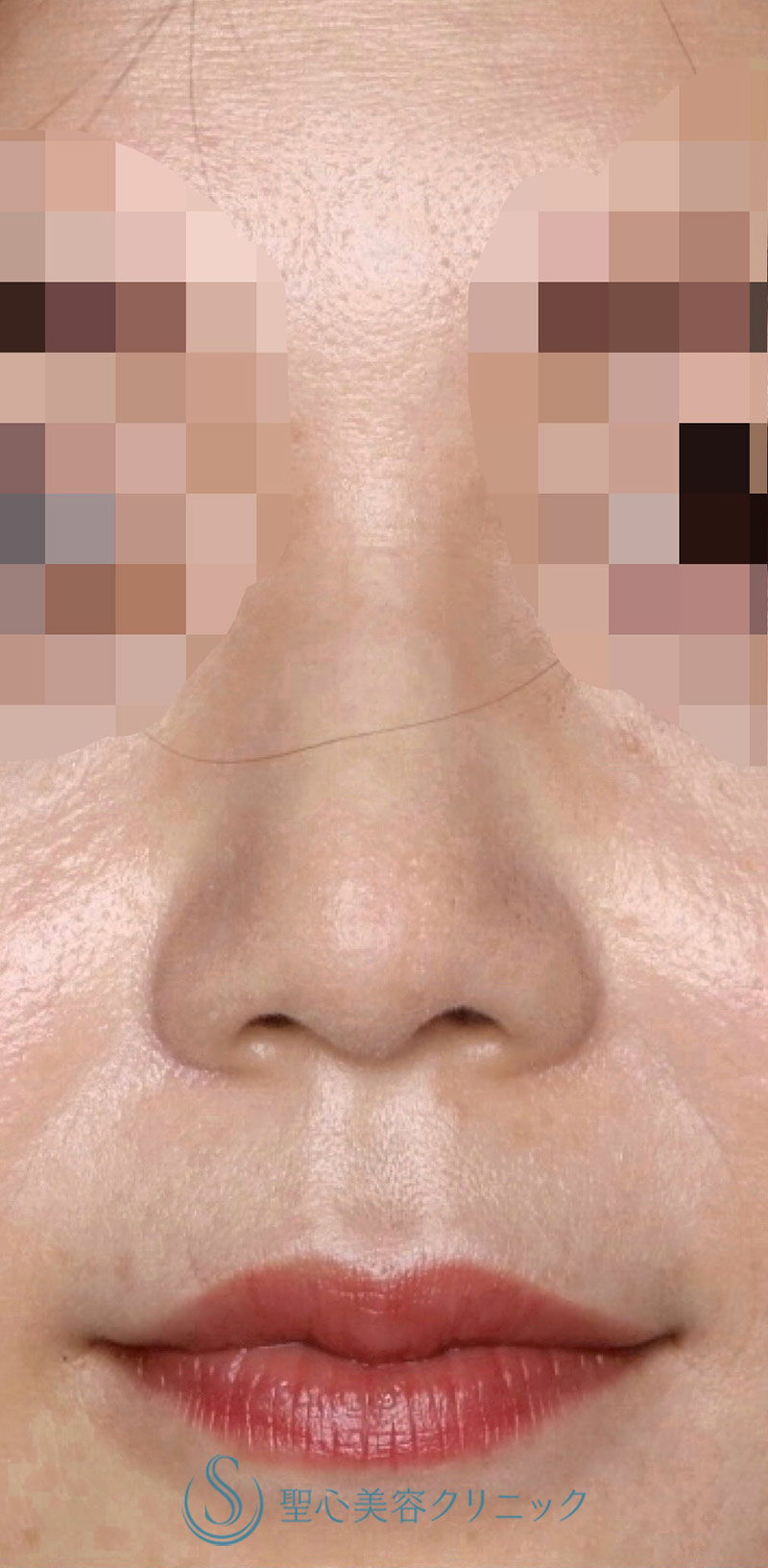 鼻尖縮小+鼻尖形成（耳介軟骨移植）+鼻尖形成（ストラット法）_After