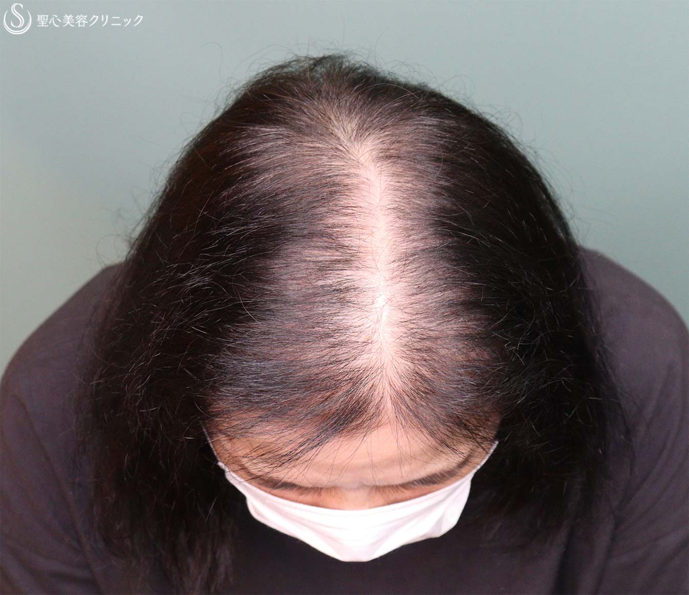 EXOHAIR EVs（エクソヘア イーヴィーズ）_Before