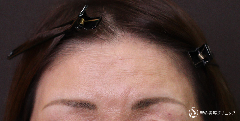 プレミアムPRP皮膚再生療法_After