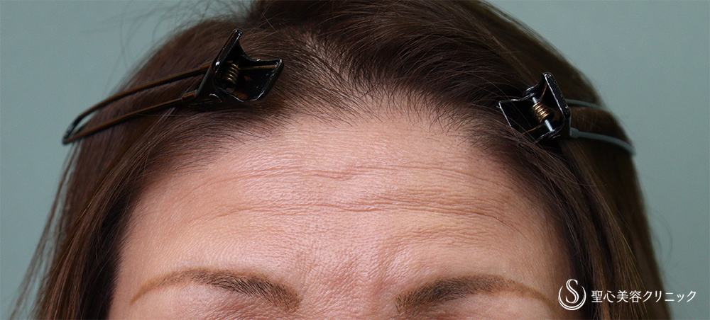 プレミアムPRP皮膚再生療法_Before