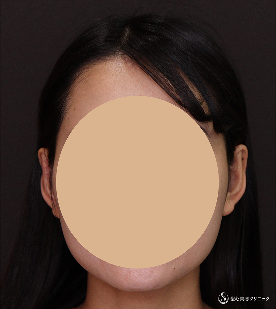 立ち耳修正（埋没法）_After