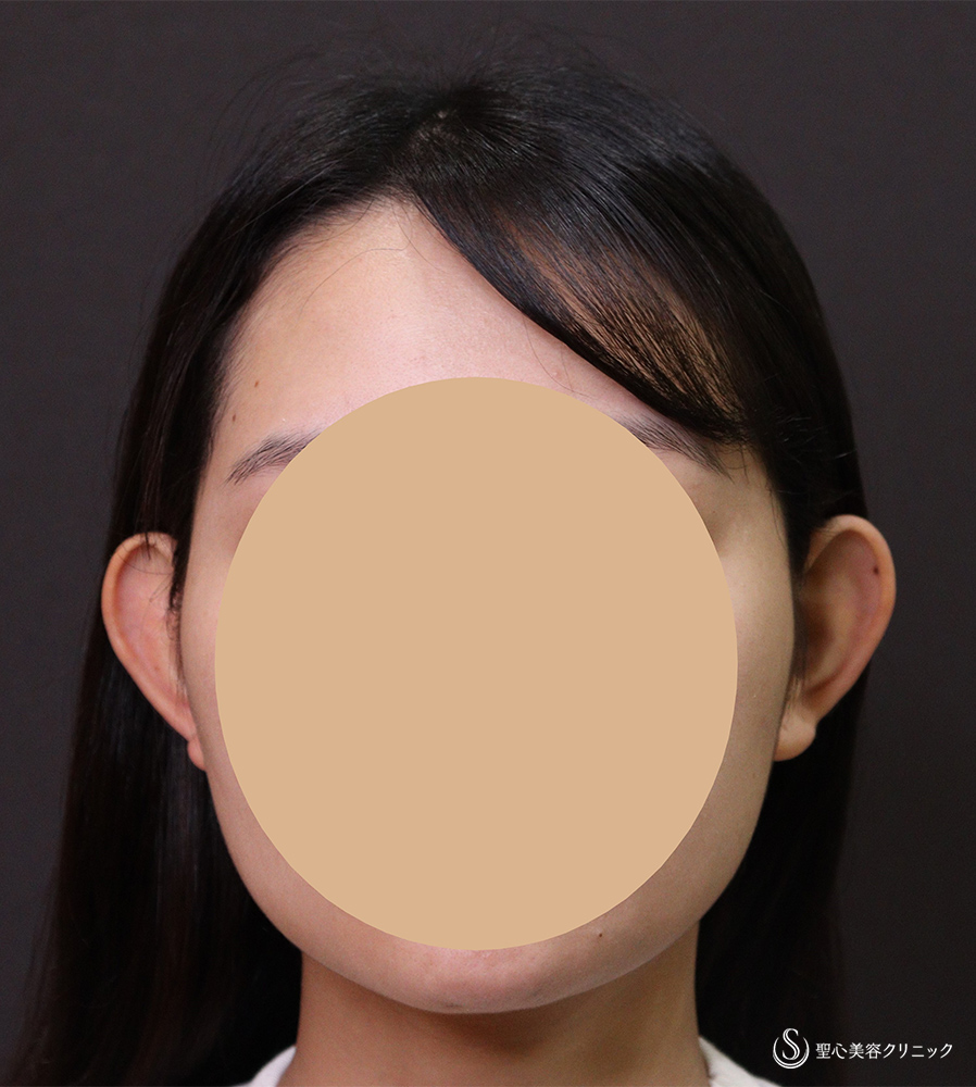 立ち耳修正（埋没法）_Before