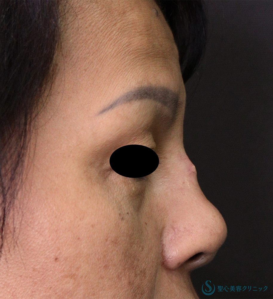 プロテーゼ取り出し・プロテーゼ入替_Before