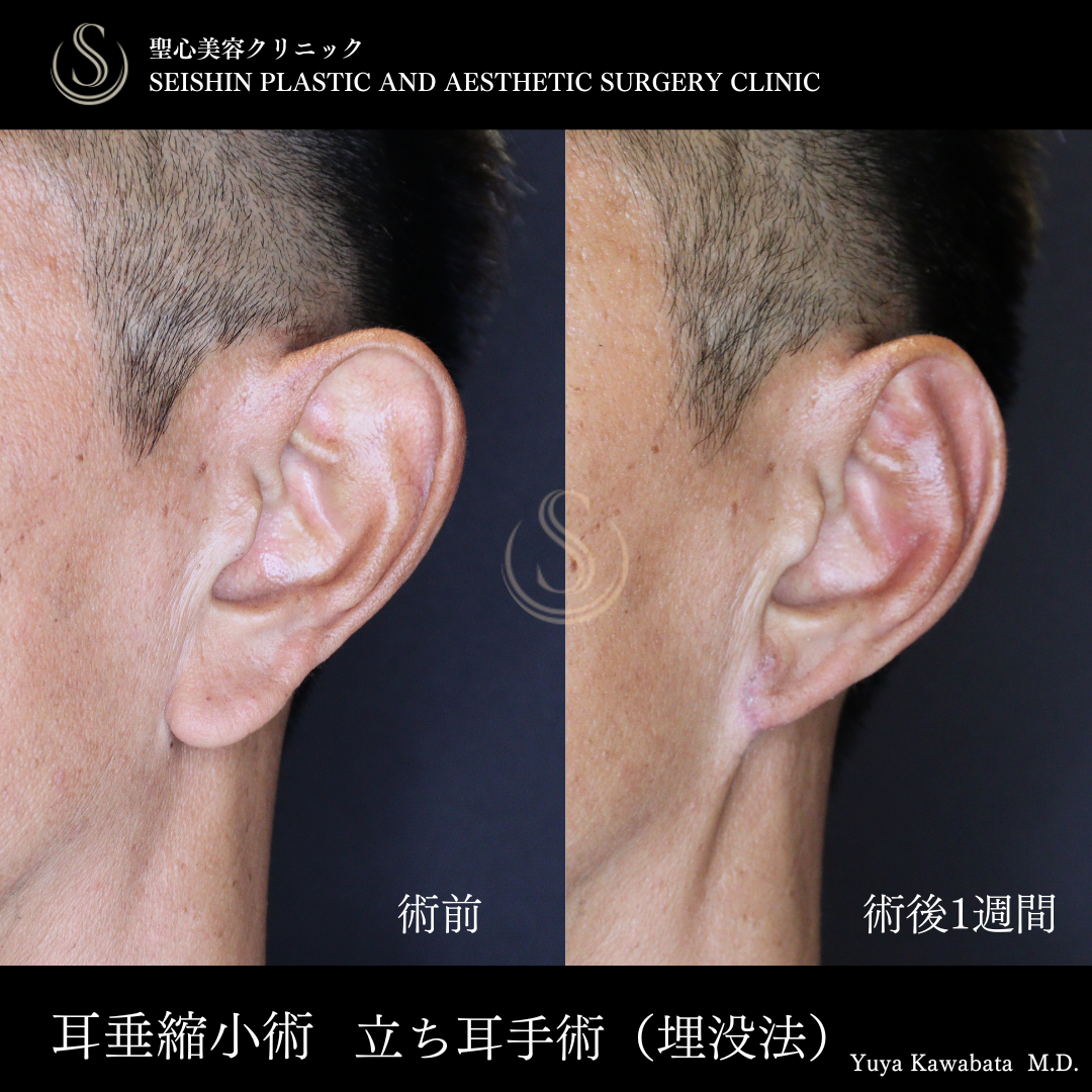 耳たぶ修正＋立ち耳修正（埋没法）_After