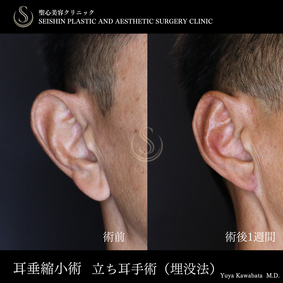 耳たぶ修正＋立ち耳修正（埋没法）_Before