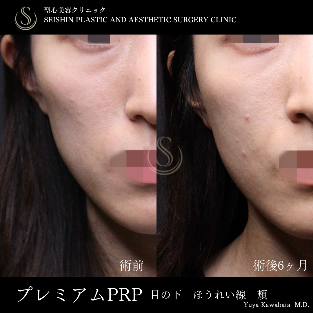 プレミアムPRP皮膚再生療法_After