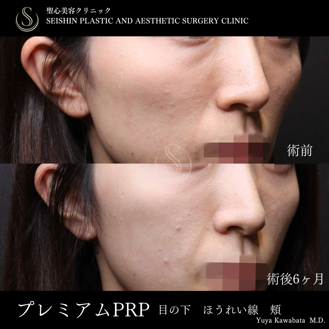 プレミアムPRP皮膚再生療法_Before