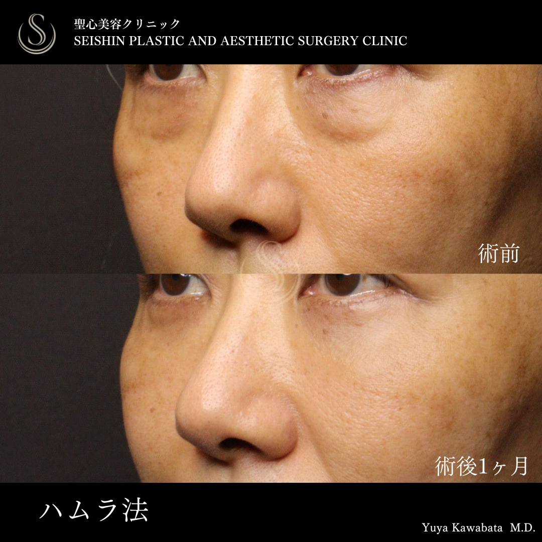 下眼瞼切開術/下眼瞼除皺術/ハムラ法_After