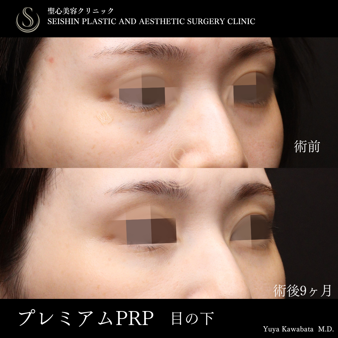 プレミアムPRP皮膚再生療法_After