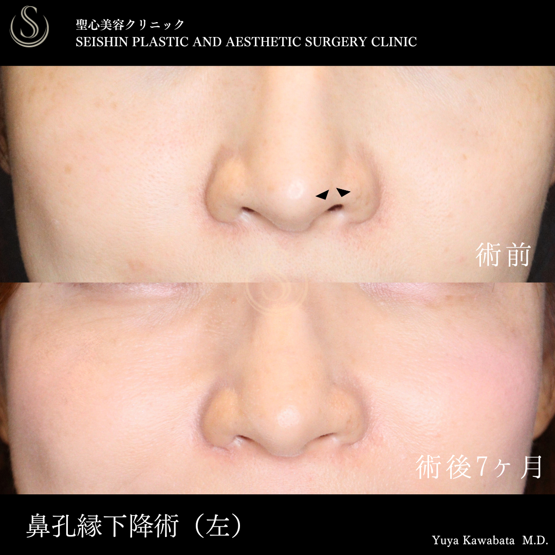 鼻孔縁下降術_After