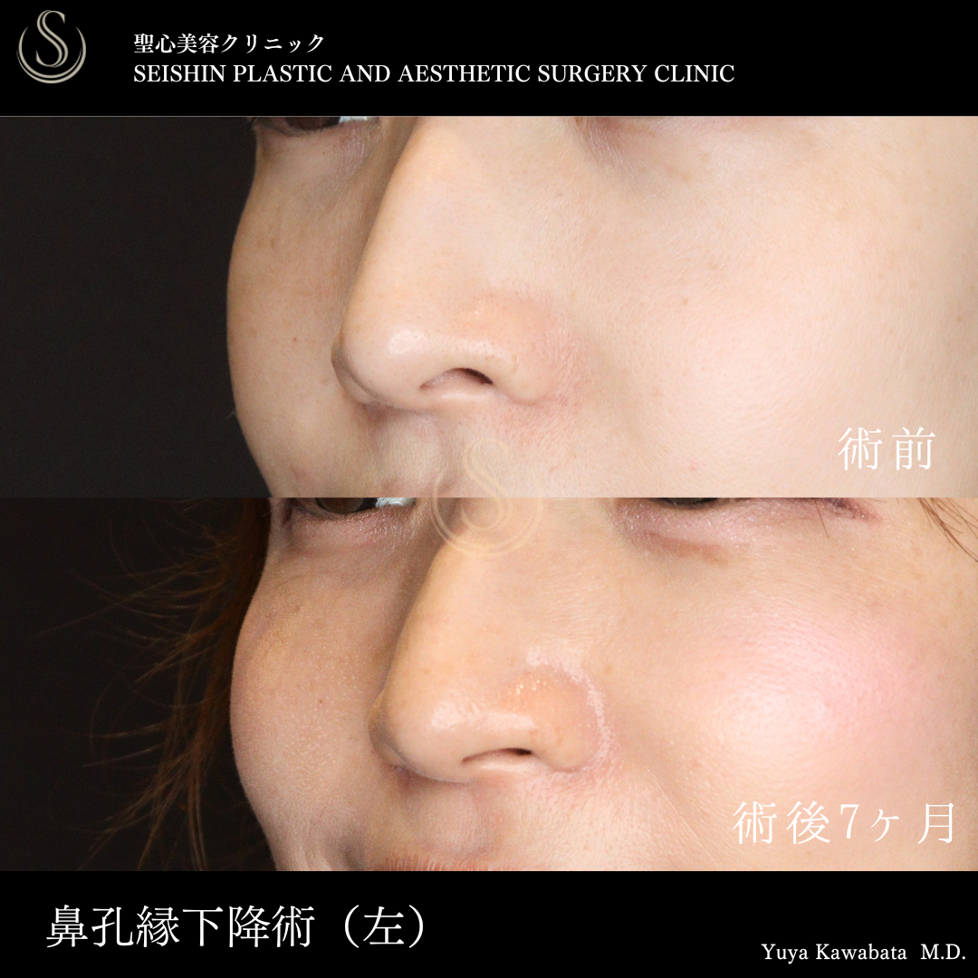 鼻孔縁下降術_Before