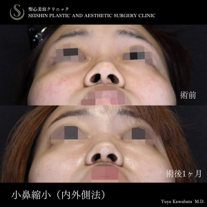 小鼻縮小_After