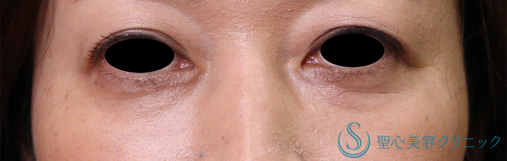 プレミアムPRP皮膚再生療法_After