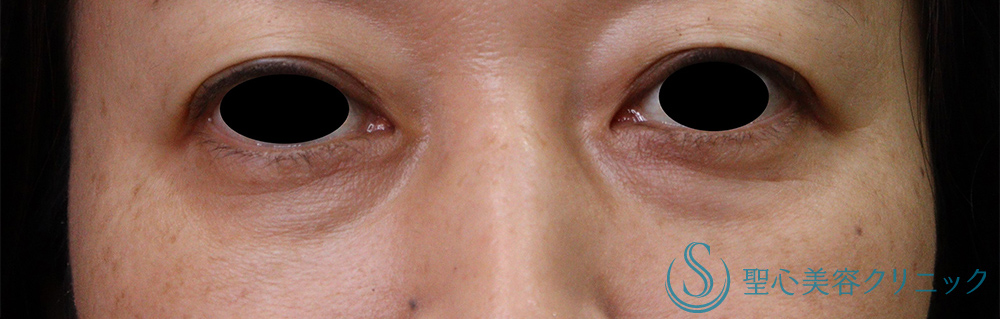 プレミアムPRP皮膚再生療法_Before