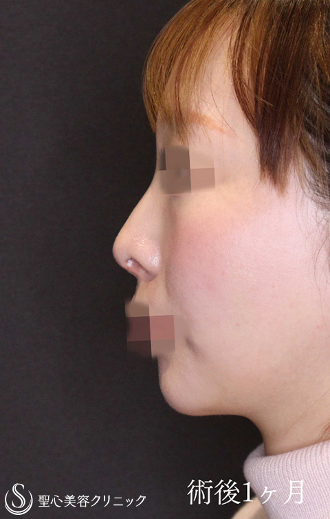 鼻中隔延長術＋鼻尖縮小＋鷲鼻修正_After