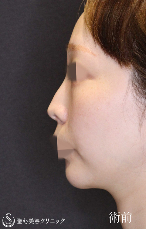 鼻中隔延長術＋鼻尖縮小＋鷲鼻修正_Before