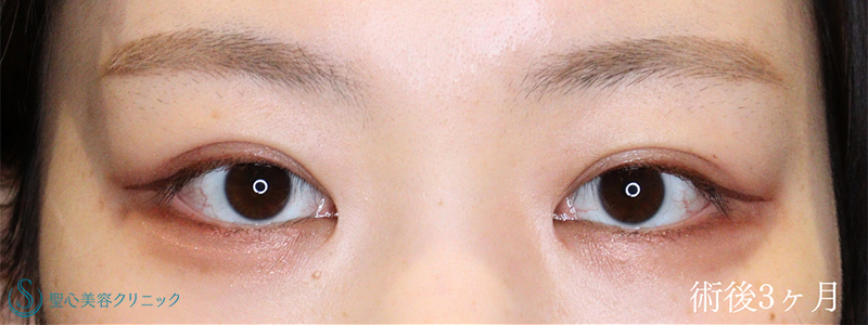 二重術（埋没法）：マイクロメソッド+α＋目頭切開/目上切開_After
