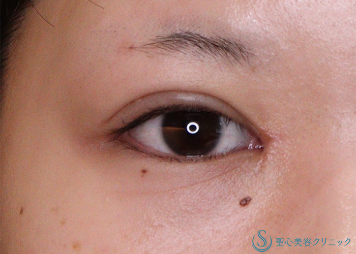 二重術（埋没法3点留め）：マイクロメソッド+α＋目頭切開_After
