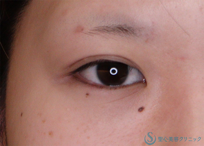 二重術（埋没法3点留め）：マイクロメソッド+α＋目頭切開_Before