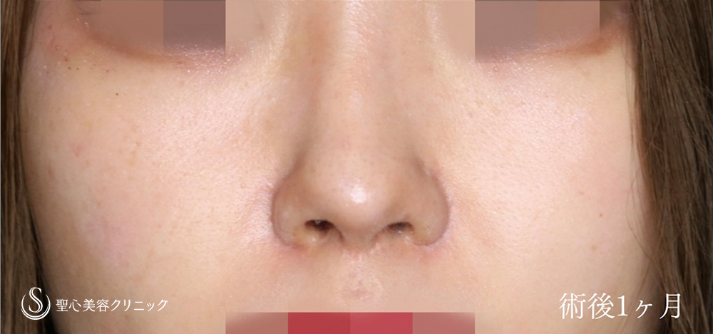 鼻孔縁下降術_After