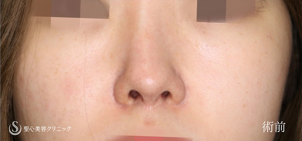 鼻孔縁下降術_Before