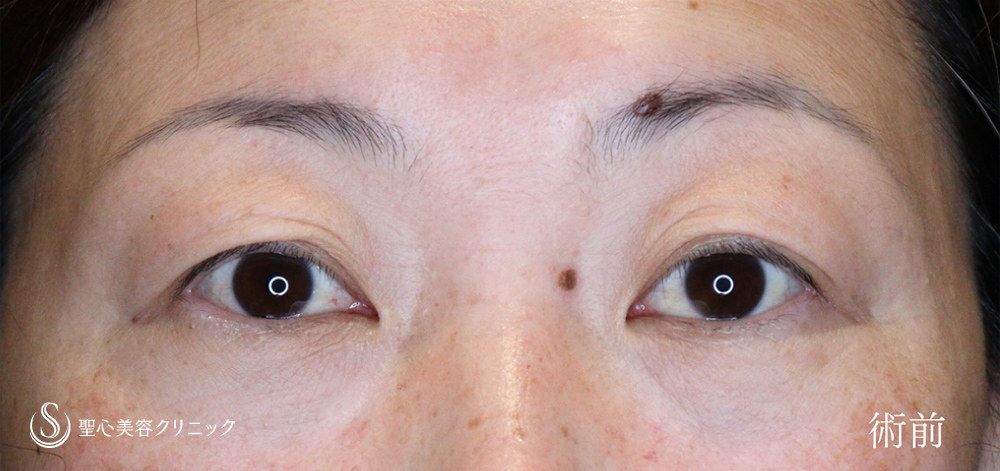 眉下切開法（眉下リフト）_Before