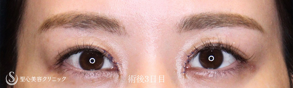 目頭切開/目上切開_After