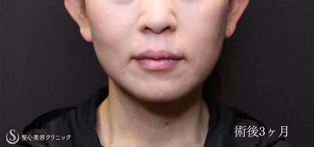 フェイスリフト＋脂肪吸引（頬＋顎）＋リガメント処置_After