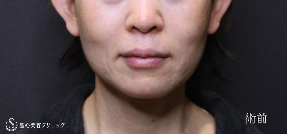フェイスリフト＋脂肪吸引（頬＋顎）＋リガメント処置_Before