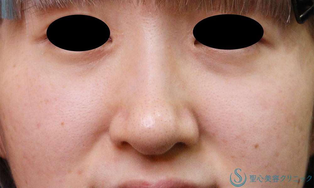 小鼻縮小＋鼻尖縮小_After