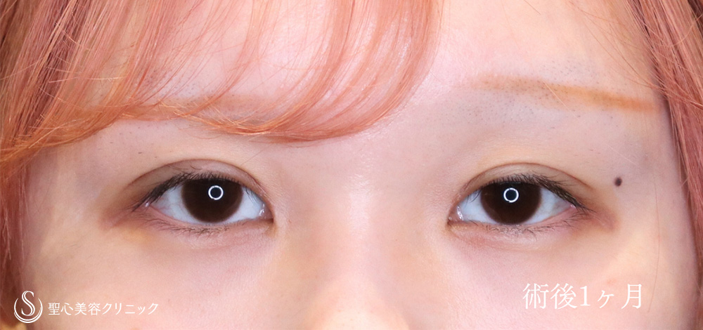 二重術（切開法）＋目上切開_After