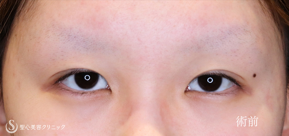 二重術（切開法）＋目上切開_Before