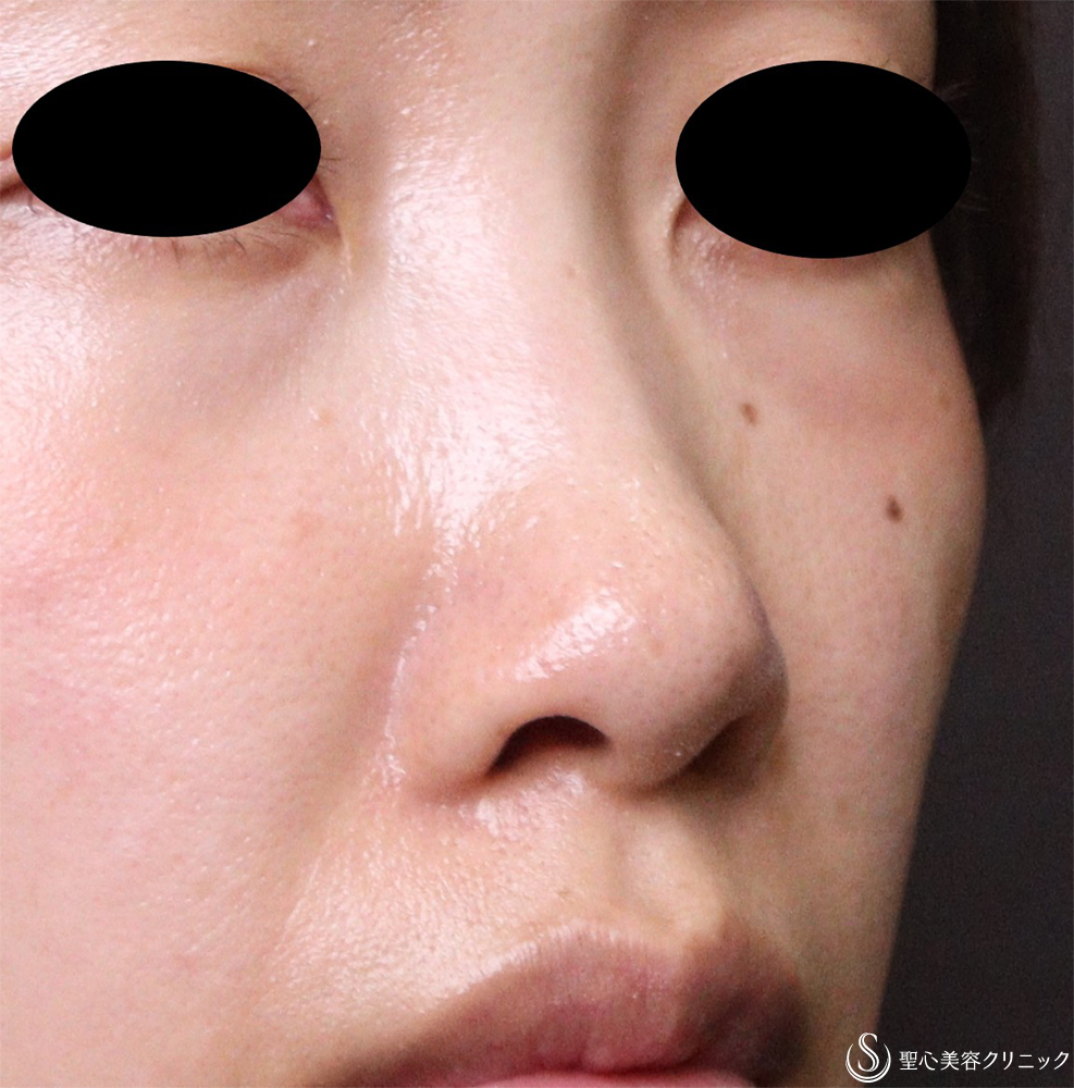鼻孔縁下降術_After