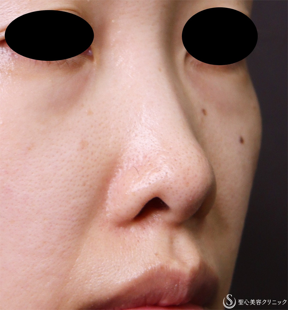 鼻孔縁下降術_Before