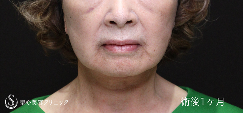 フェイスリフト_After